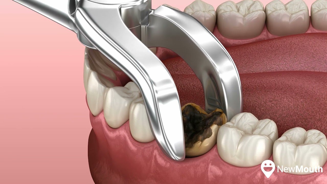 How Much Does It Cost To Have Tooth Pulled